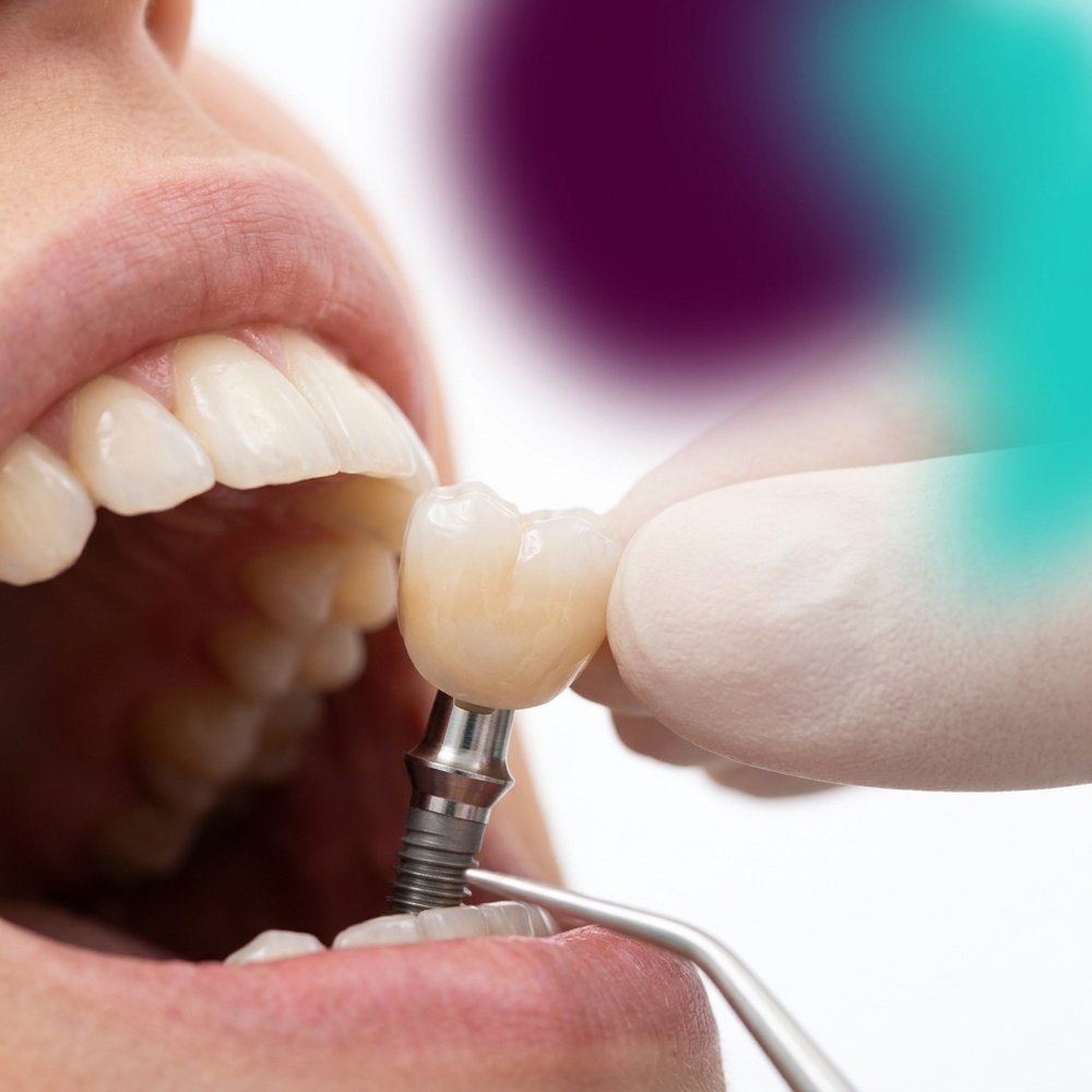 Prótese dentária fixa instalada sobre implante